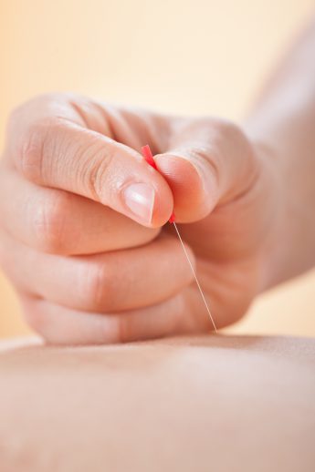 Dry Needling